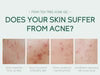 Acne medicine, tea tree oil