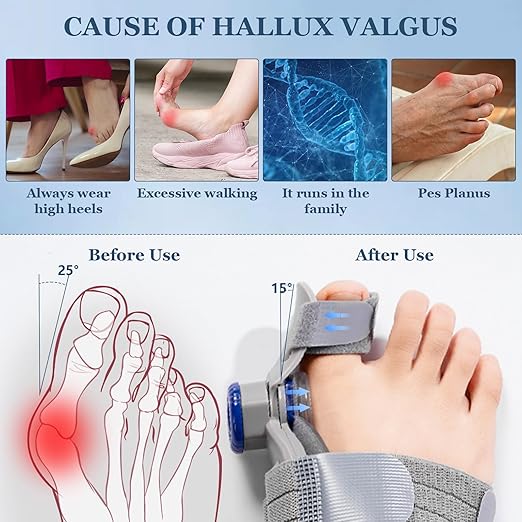 FeetFix Bunion Corrector