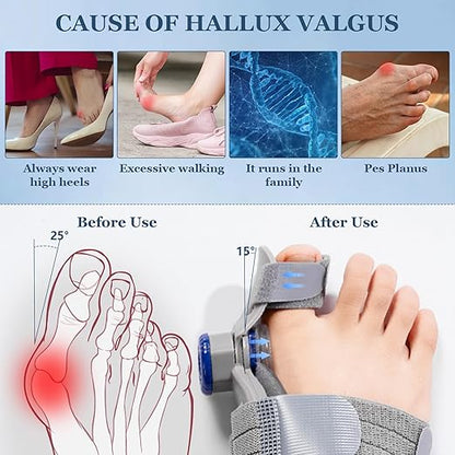 FeetFix Bunion Corrector